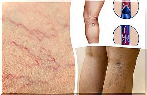 4 herbal remedies that help reduce varicose veins and spider veins