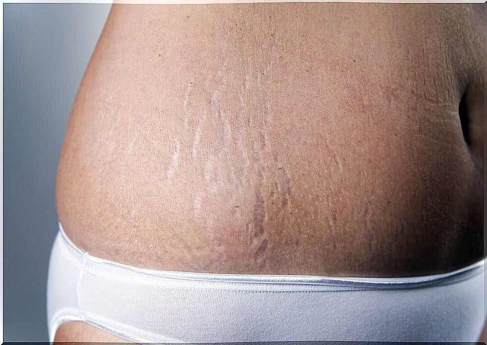 Vitamin capsule helps to minimize stretch marks