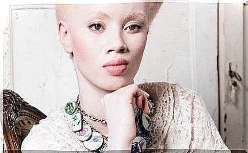 Albinism: the moving case of model Thando Hopa