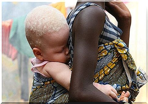 The curse of being albino in Africa