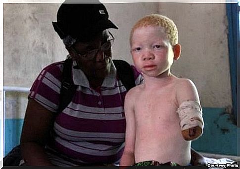 The reality of albinism in Africa