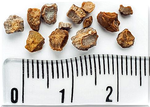 What-To-Know-About-Kidney Stones