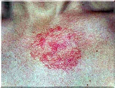 Betamethasone is widely used for dermatitis