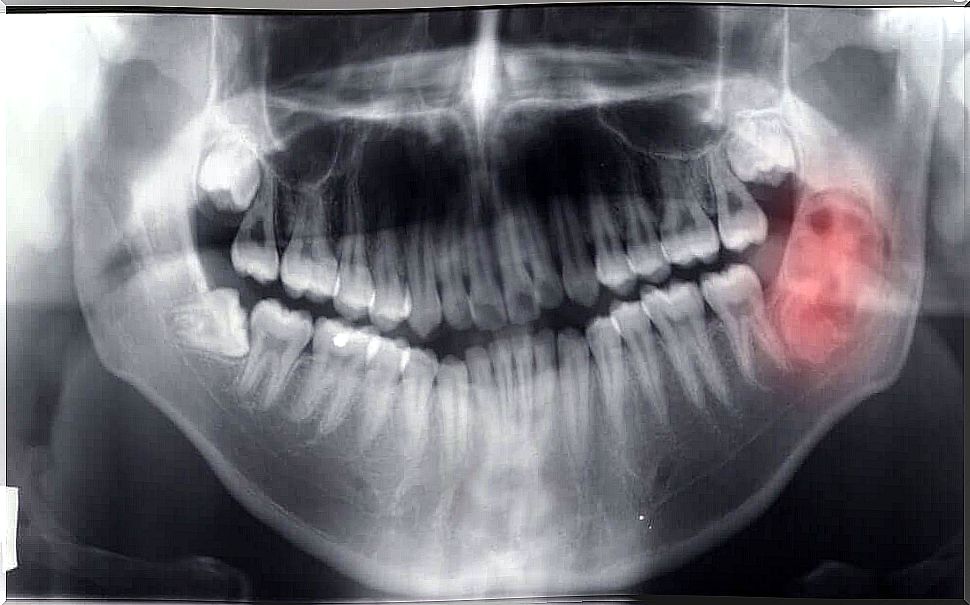 Diagnosis of mandibular tumors and cysts