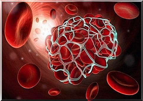 clots in thrombosis