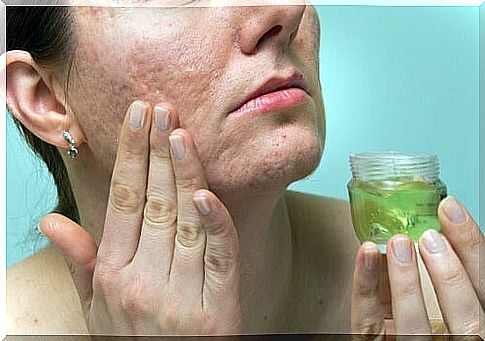 Woman applying aloe vera gel on her face