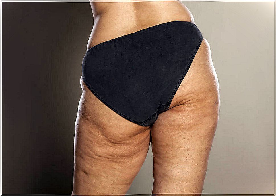 How to reduce cellulite