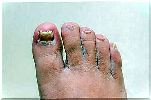 Remedies for onychomycosis in the hands and feet