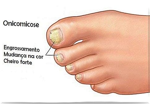 Onychomycosis: when fungi are on the nails 