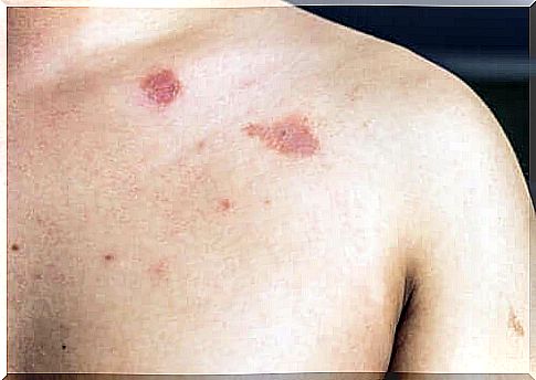 What is pityriasis versicolor?