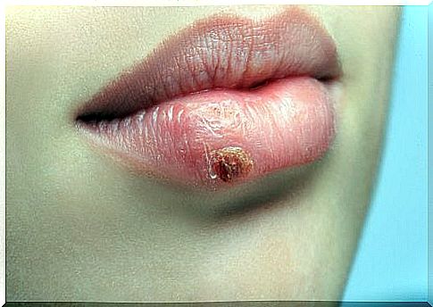 Why does cold sores always recur?